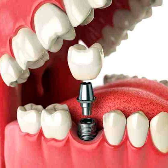 Implante-dental-Dentobel-2