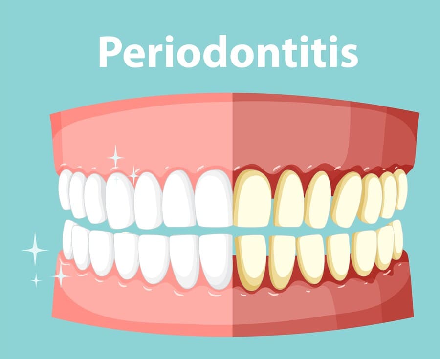 Que es la Periodontitis