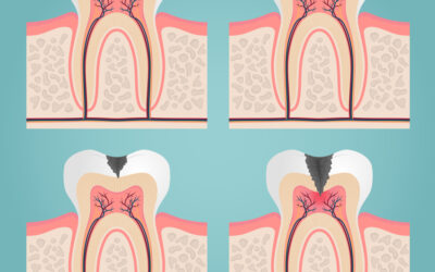 ¿Cuándo es necesaria una endodoncia?