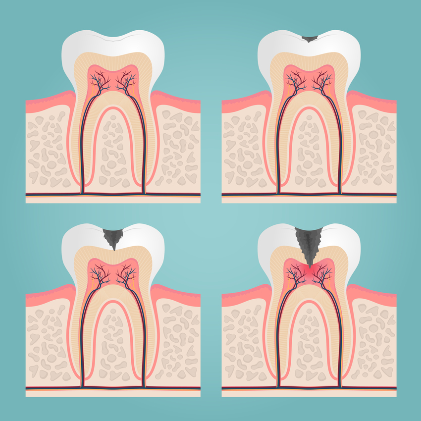 Síntomas de alerta a tener en cuenta para una endodoncia