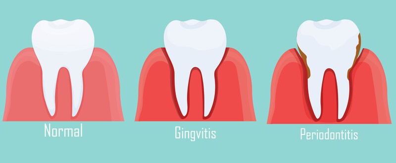 Como Tratar Una Periodontitis