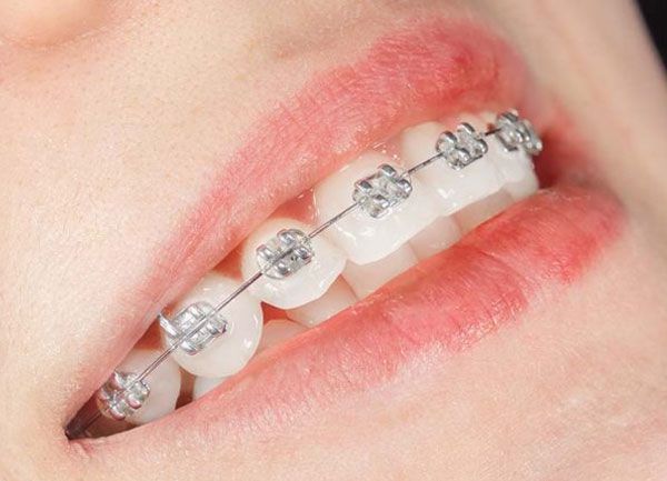 Como usar hilo dental con brackets